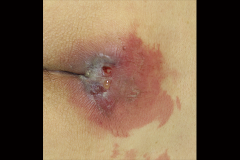 クイズで学ぶ 皮膚科診療の“新常識” | Dermado デルマド - マルホ株式会社 皮膚科学領域での卓越した貢献を。